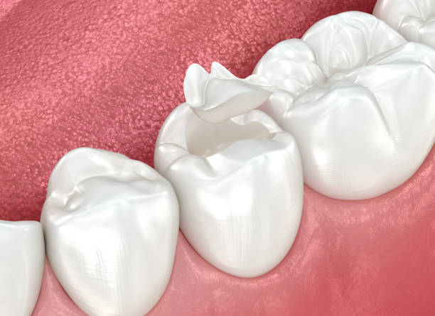 Dental Inlays and Onlays in Millington, NJ